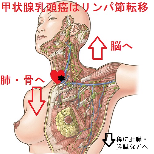 甲状腺乳頭癌はリンパ行性に脳転移 甲状腺乳頭癌はリンパ行性に脳転移