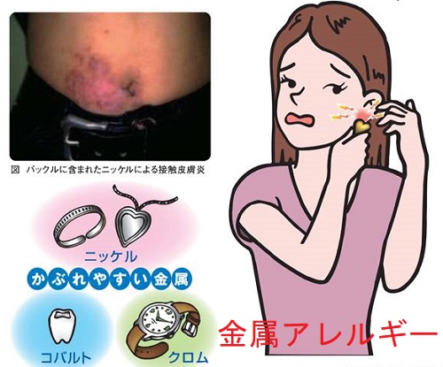 金属アレルギー 金属アレルギー