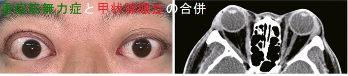 重症筋無力症と甲状腺眼症の合併 重症筋無力症と甲状腺眼症の合併