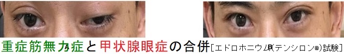 重症筋無力症と甲状腺眼症の合併 重症筋無力症と甲状腺眼症2