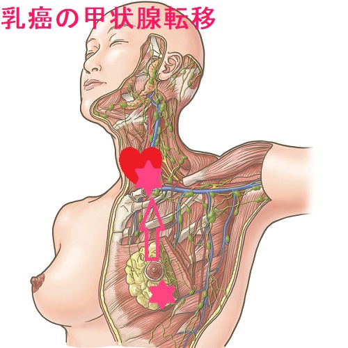 乳癌の甲状腺転移 乳癌の甲状腺転移