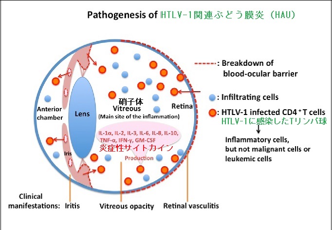 HTLV-1関連ぶどう膜炎(HAU) HTLV-1関連ぶどう膜炎(HAU)