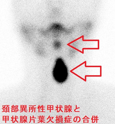頚部異所性甲状腺と甲状腺片葉欠損症の合併 頚部異所性甲状腺と甲状腺片葉欠損症の合併