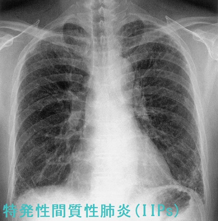 特発性間質性肺炎 胸部X線 特発性間質性肺炎 胸部X線