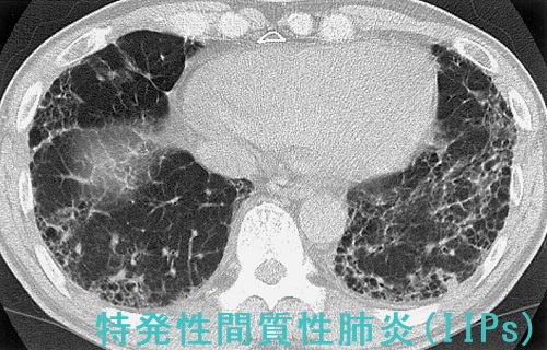 特発性間質性肺炎 CT 特発性間質性肺炎 CT