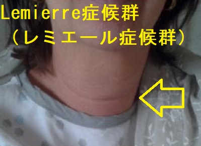 亜急性甲状腺炎、急性化膿性甲状腺炎/甲状腺膿瘍と鑑別を要したLemierre症候群(レミエール症候群) 亜急性甲状腺炎、急性化膿性甲状腺炎/甲状腺膿瘍と鑑別を要したLemierre症候群(レミエール症候群)