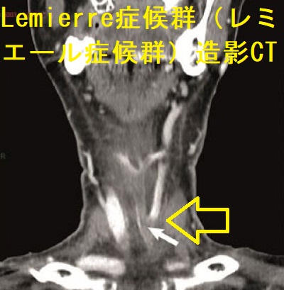 亜急性甲状腺炎、急性化膿性甲状腺炎/甲状腺膿瘍と鑑別を要したLemierre症候群(レミエール症候群)造影CT 亜急性甲状腺炎、急性化膿性甲状腺炎/甲状腺膿瘍と鑑別を要したLemierre症候群(レミエール症候群)造影CT
