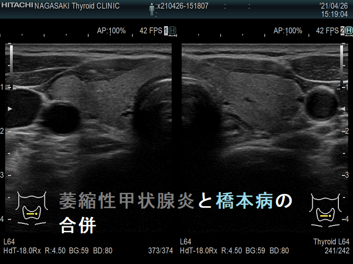 萎縮性甲状腺炎と橋本病の合併 超音波(エコー)画像 萎縮性甲状腺炎と橋本病の合併 超音波(エコー)画像