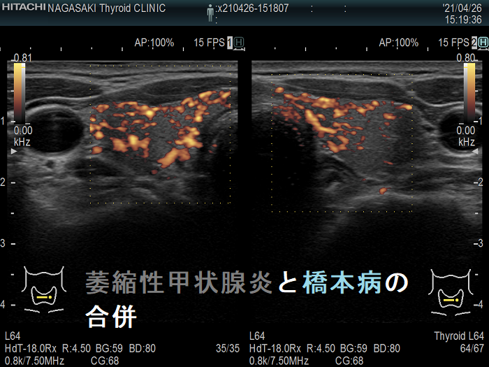 萎縮性甲状腺炎と橋本病の合併 超音波(エコー)画像 ドプラーモード 萎縮性甲状腺炎と橋本病の合併 超音波(エコー)画像 ドプラーモード