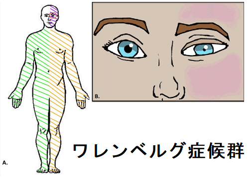 ワレンベルグ症候群 ワレンベルグ症候群