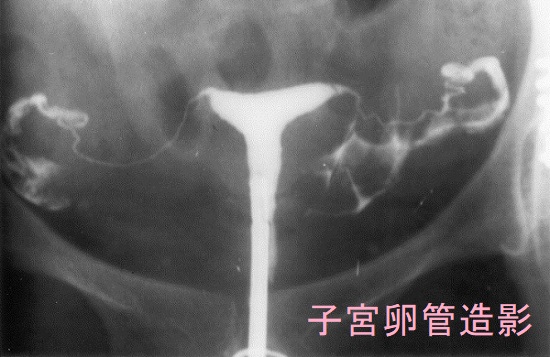 子宮卵管造影検査 子宮卵管造影検査