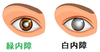 甲状腺と白内障、緑内障 甲状腺と白内障、緑内障
