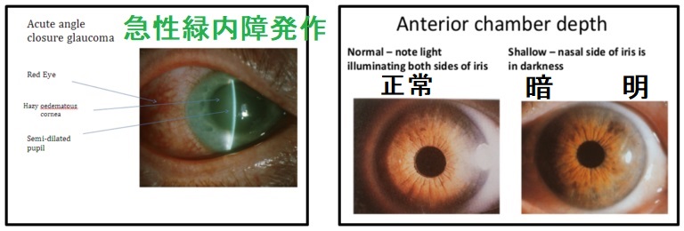 急性緑内障発作 急性緑内障発作
