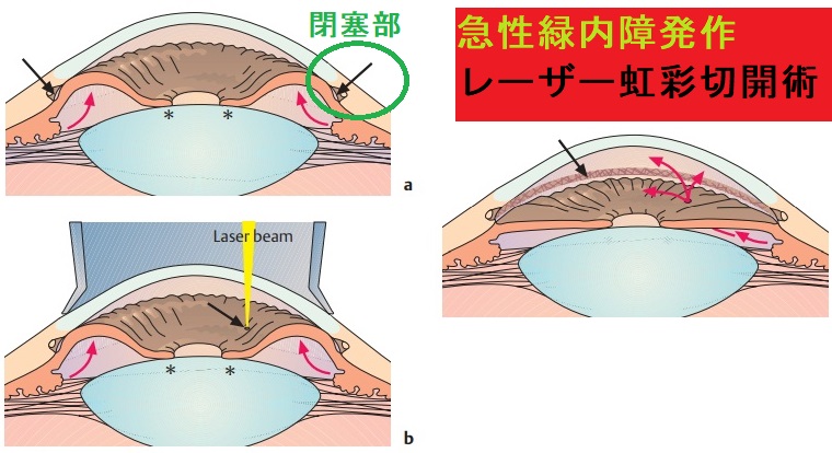 急性緑内障発作 レーザー虹彩切開術 急性緑内障発作 レーザー虹彩切開術