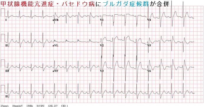 甲状腺機能亢進症・バセドウ病にブルガダ(Brugada)症候群が合併 甲状腺機能亢進症・バセドウ病にブルガダ(Brugada)症候群が合併