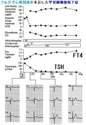 ブルガダ心電図波形を示した甲状腺機能低下症 ブルガダ心電図波形を示した甲状腺機能低下症