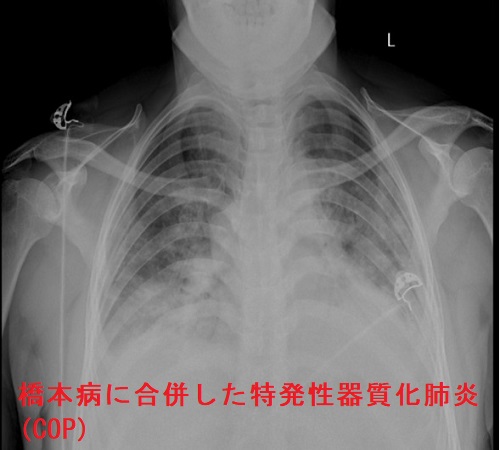 潜在性甲状腺機能低下症/橋本病(慢性甲状腺炎)に合併した特発性器質化肺炎(COP) 潜在性甲状腺機能低下症/橋本病(慢性甲状腺炎)に合併した特発性器質化肺炎(COP)