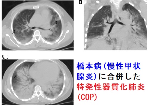 橋本病(慢性甲状腺炎)に合併した特発性器質化肺炎(COP) 橋本病(慢性甲状腺炎)に合併した特発性器質化肺炎(COP)