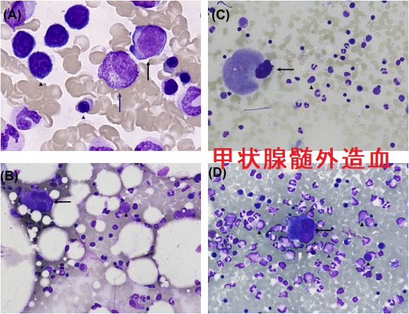 甲状腺髄外造血 穿刺細胞診 甲状腺髄外造血 穿刺細胞診