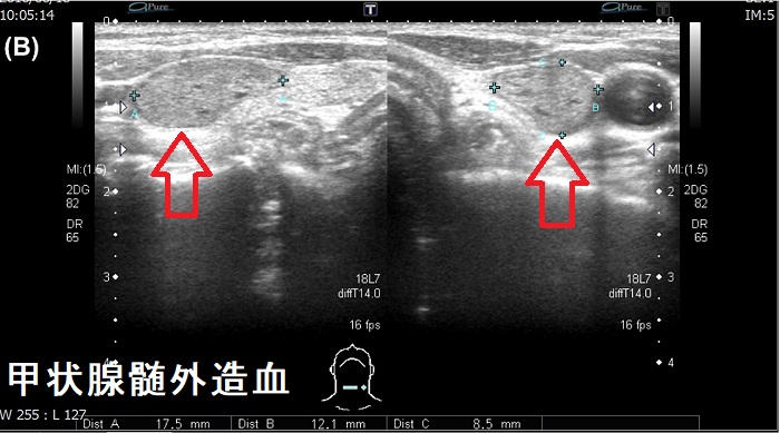甲状腺髄外造血 超音波(エコー)画像 腺腫様甲状腺腫様 甲状腺髄外造血 超音波(エコー)画像 腺腫様甲状腺腫様