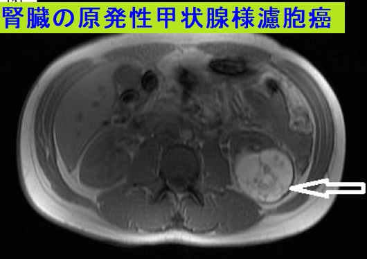 腎臓の原発性甲状腺様濾胞癌 MRI画像 腎臓の原発性甲状腺様濾胞癌 MRI画像