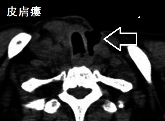レンビマ®(レンバチニブ)投与後の皮膚瘻 レンビマ®(レンバチニブ)投与後の皮膚瘻