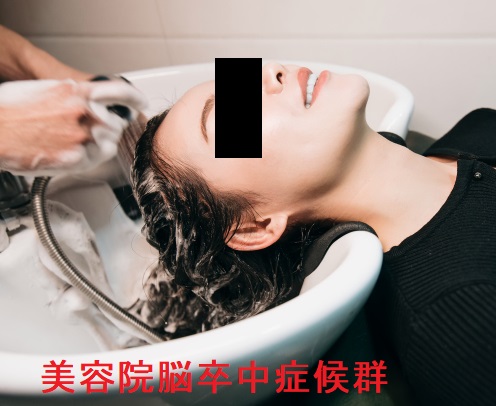 美容院脳卒中症候群 美容院脳卒中症候群