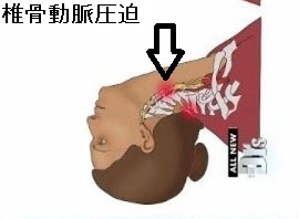 美容院脳卒中症候群 美容院脳卒中症候群
