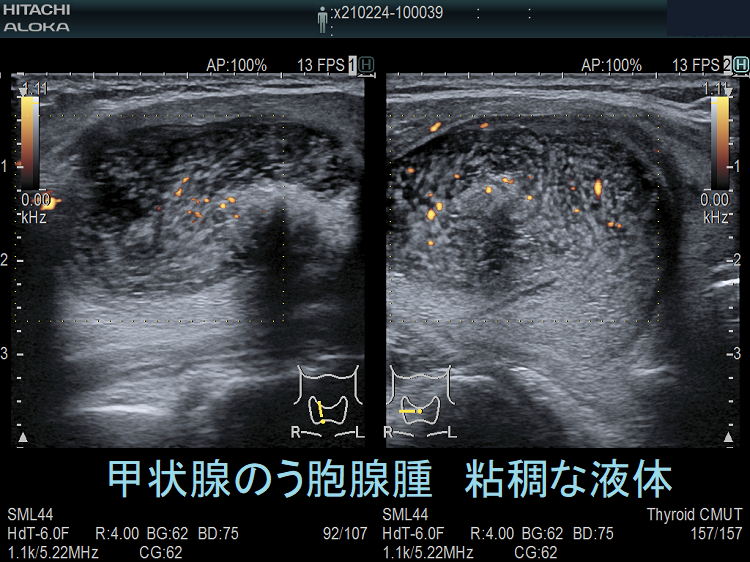 甲状腺のう胞腺腫 粘稠な液体 ドプラーモード; 甲状腺のう胞腺腫 粘稠な液体 ドプラーモード