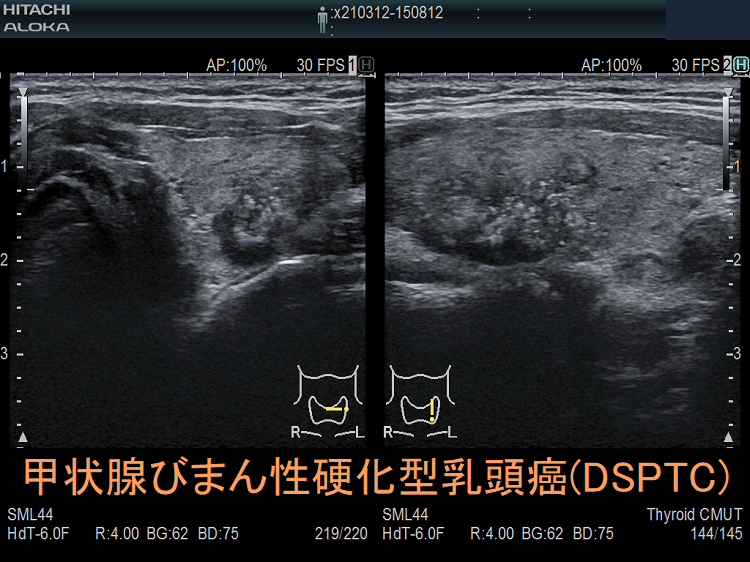 甲状腺びまん性硬化型乳頭癌(DSPTC) ・(小児)甲状腺乳頭癌充実亜