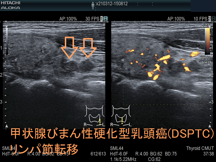 甲状腺びまん性硬化型乳頭癌(DSPTC) 超音波(エコー)画像 転移リンパ節 甲状腺びまん性硬化型乳頭癌(DSPTC) 超音波(エコー)画像 転移リンパ節