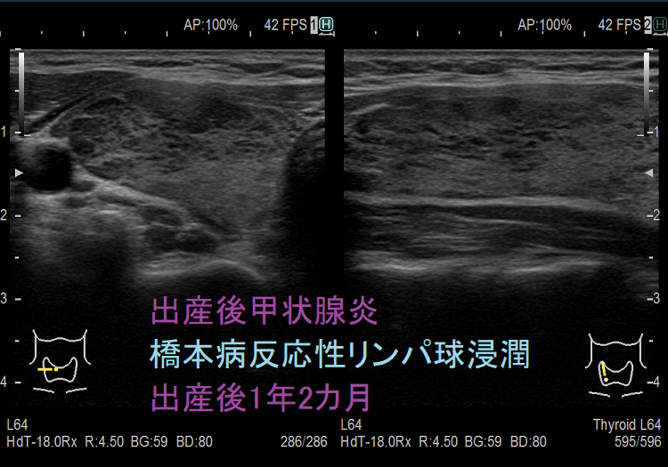 出産後甲状腺炎 橋本病反応性リンパ球浸潤 出産後1年2カ月 出産後甲状腺炎 橋本病反応性リンパ球浸潤 出産後1年2カ月