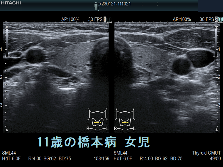 11歳の橋本病(慢性甲状腺炎) 女児の胸腺 11歳の橋本病(慢性甲状腺炎) 女児の胸腺
