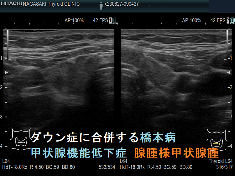 ダウン症に合併する橋本病 甲状腺機能低下症 腺腫様甲状腺腫 超音波(エコー)画像(横断像) ダウン症に合併する橋本病 甲状腺機能低下症 腺腫様甲状腺腫 超音波(エコー)画像(横断像)