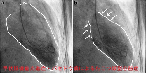 甲状腺機能亢進症・バセドウ病によるたこつぼ型心筋症 甲状腺機能亢進症・バセドウ病によるたこつぼ型心筋症