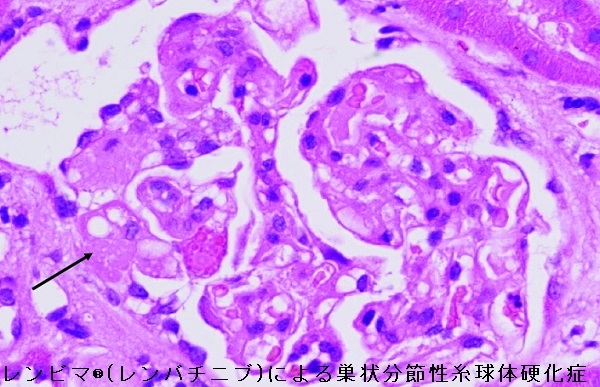レンビマ®(レンバチニブ)による巣状分節性糸球体硬化症 レンビマ®(レンバチニブ)による巣状分節性糸球体硬化症