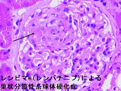 レンビマ®(レンバチニブ)による巣状分節性糸球体硬化症(FSGS) レンビマ®(レンバチニブ)による巣状分節性糸球体硬化症(FSGS)
