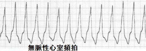 無脈性心室頻拍 無脈性心室頻拍