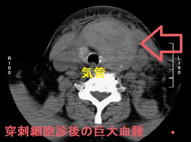 穿刺細胞診後の巨大血腫 穿刺細胞診後の巨大血腫