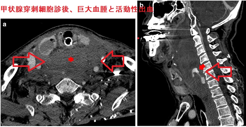 甲状腺穿刺細胞診後、巨大血腫と活動性出血 甲状腺穿刺細胞診後、巨大血腫と活動性出血