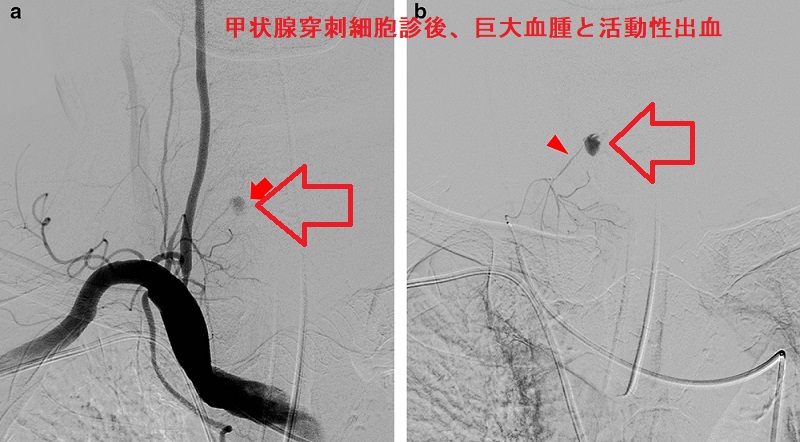 甲状腺穿刺細胞診後、巨大血腫と活動性出血 甲状腺穿刺細胞診後、巨大血腫と活動性出血2