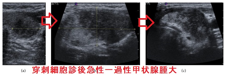 穿刺細胞診後急性一過性甲状腺腫大 穿刺細胞診後急性一過性甲状腺腫大