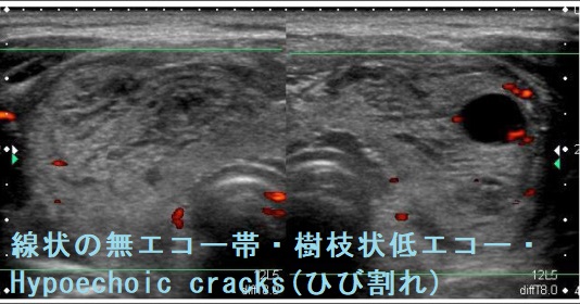 線状の無エコー帯・樹枝状低エコー・Hypoechoic cracks(ひび割れ) 線状の無エコー帯・樹枝状低エコー・Hypoechoic cracks(ひび割れ)2