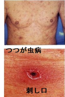 つつが虫病 つつが虫病