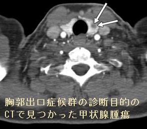 胸郭出口症候群の診断目的のCTで見つかった甲状腺腫瘍 胸郭出口症候群の診断目的のCTで見つかった甲状腺腫瘍