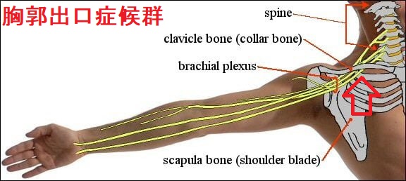 胸郭出口症候群 胸郭出口症候群