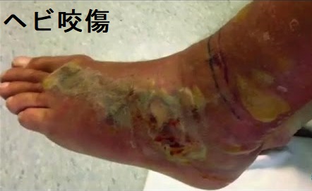ヘビ咬傷と甲状腺 ヘビ咬傷と甲状腺