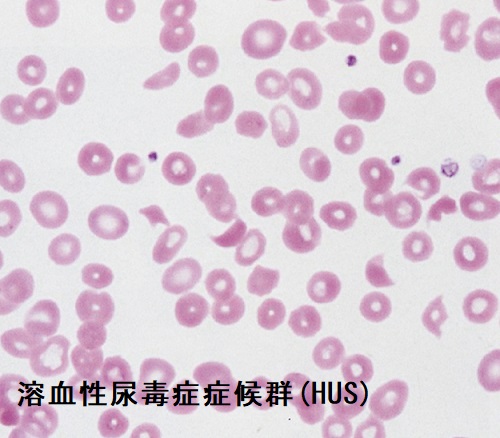 溶血性尿毒症症候群〈HUS〉 溶血性尿毒症症候群〈HUS〉