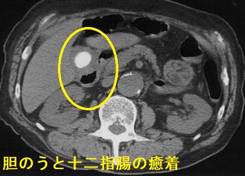 十二指腸と胆のうの癒着 十二指腸と胆のうの癒着