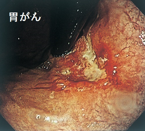 胃癌 胃癌